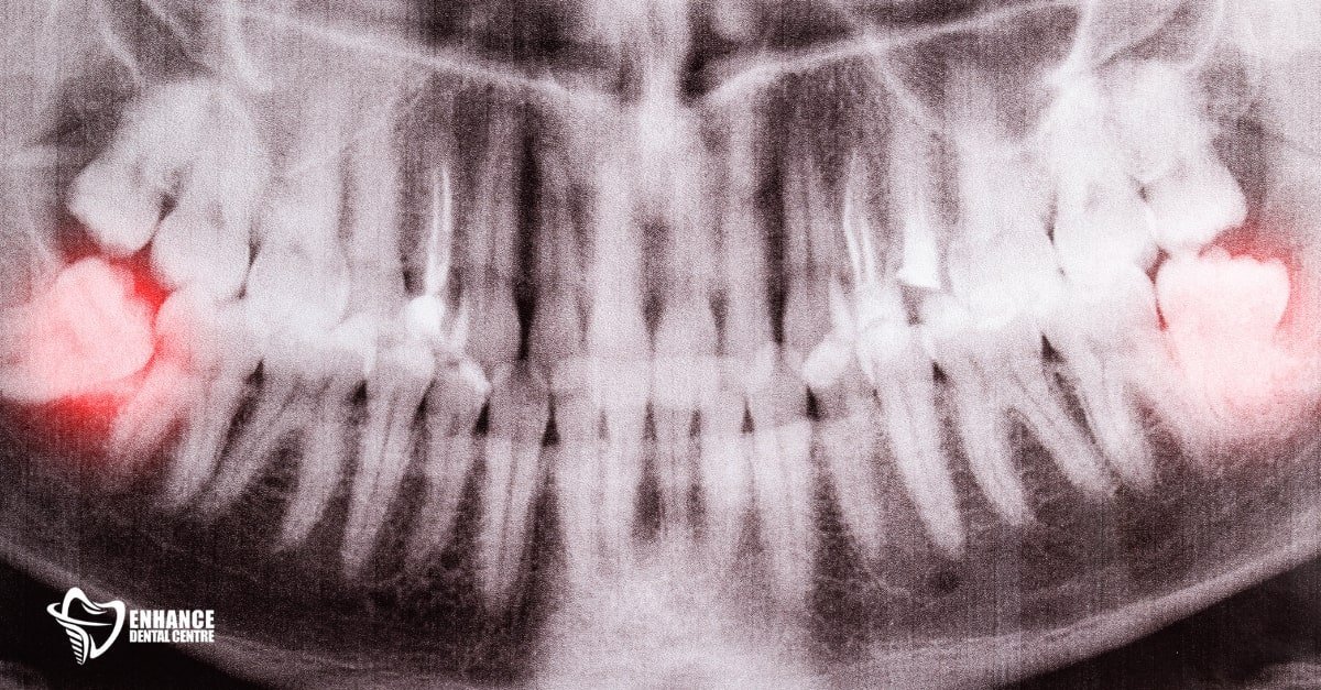 X-ray showing an angled impacted wisdom tooth