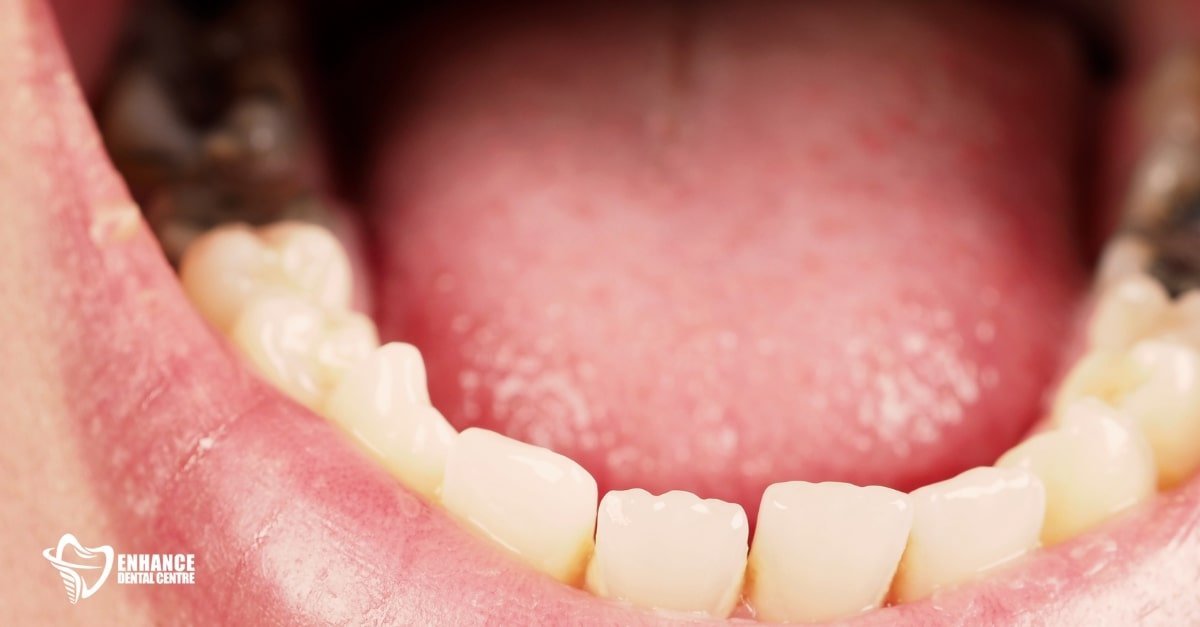 Swollen, red gum tissue near a tooth extraction site with visible pus