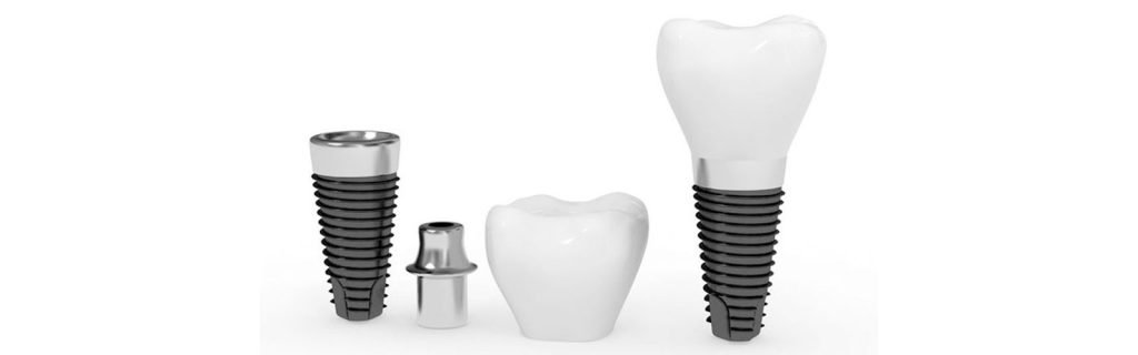 Dental Implants in Kitsilano