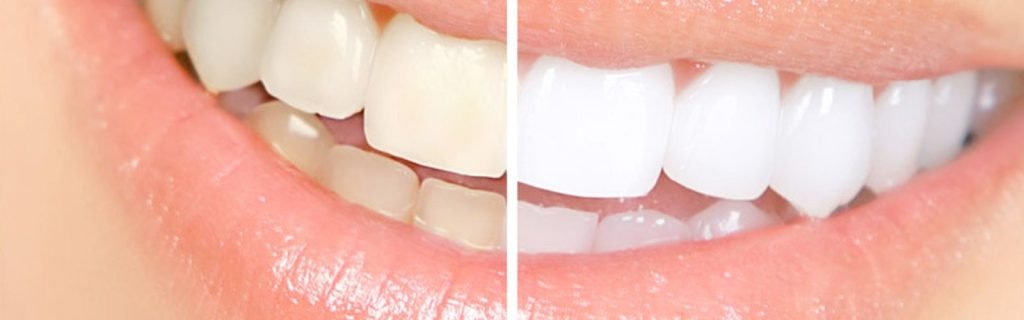 Stained Teeth