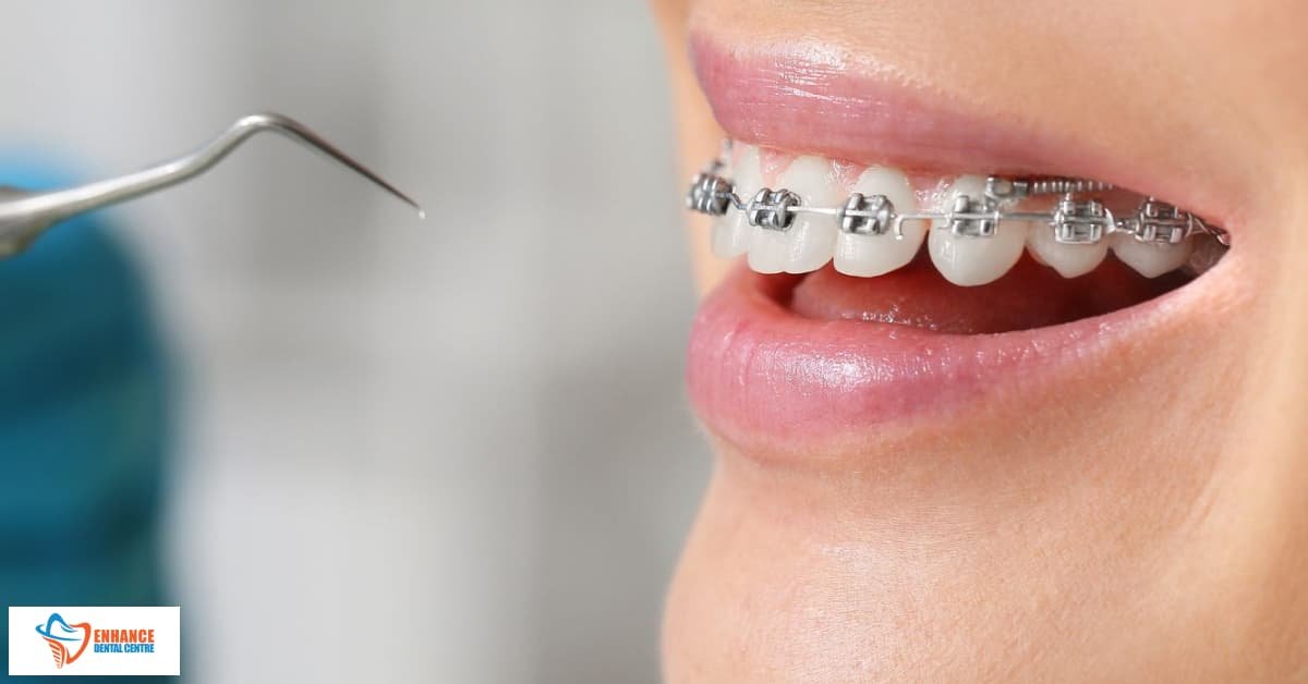 Discreet Bonded Retainers For Teeth