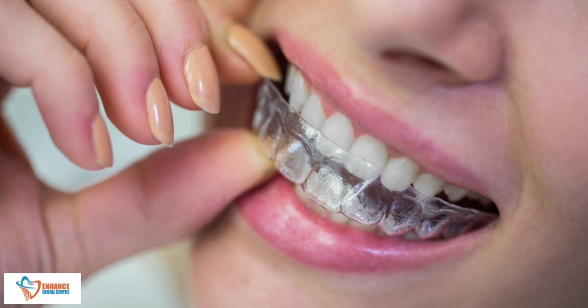 Dental Orthodontic Essix Retainer
