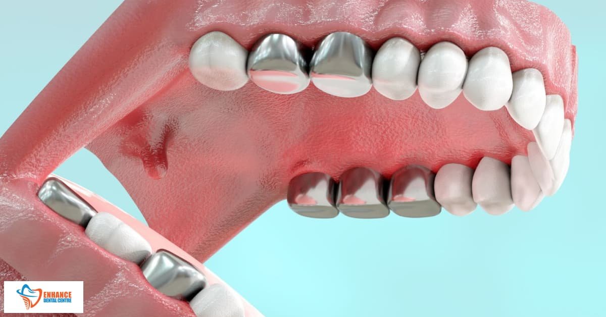 Porcelain-Fused-to-Metal Crowns (PFM) as one of the main types of dental crown