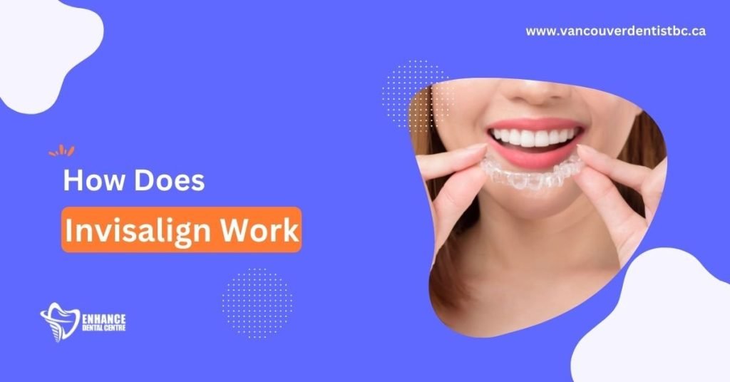 The Complete Guide on How Invisalign Works