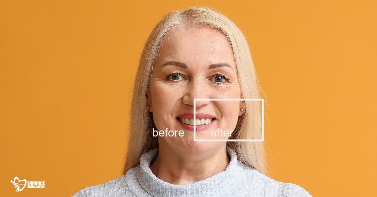Benefits of Dental Implants