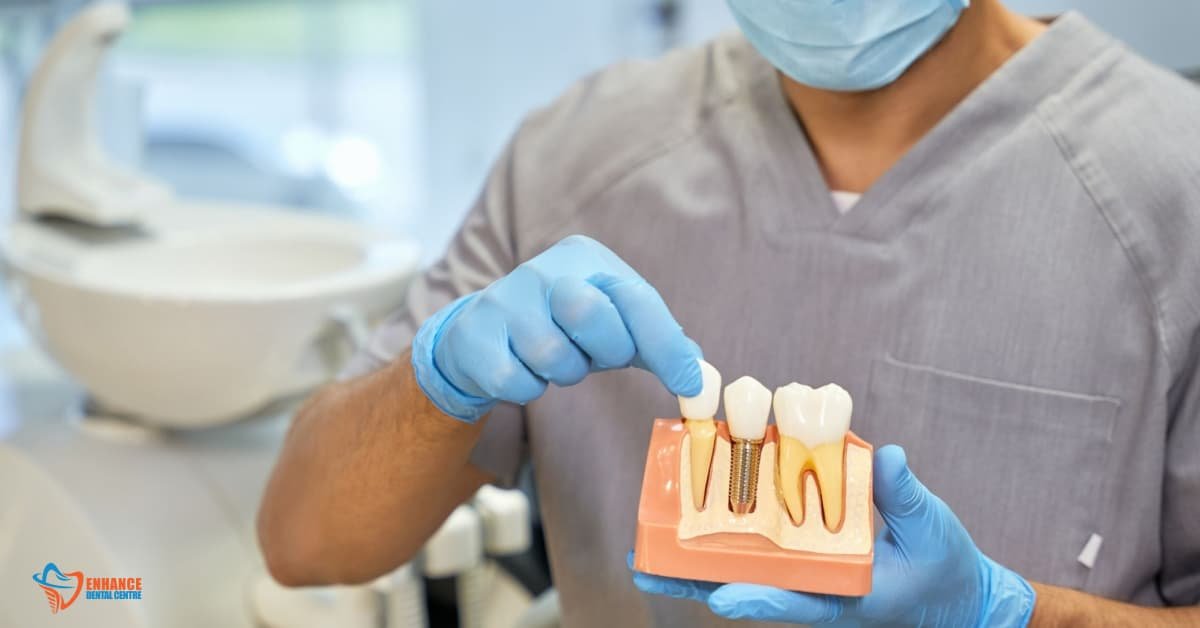 Dental bridge