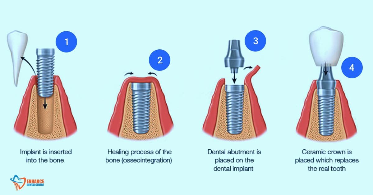 Dental Implants Procedure