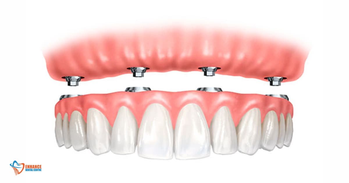 Benefits of Implant-Supported Dentures