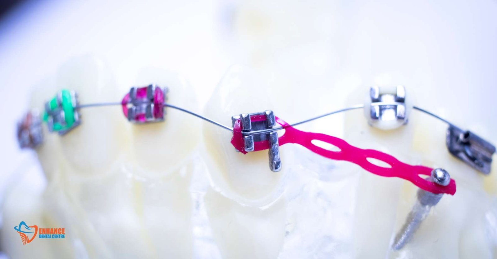 Children's Orthodontic Treatment Options