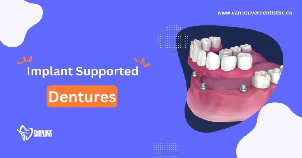 Implant-Supported Dentures