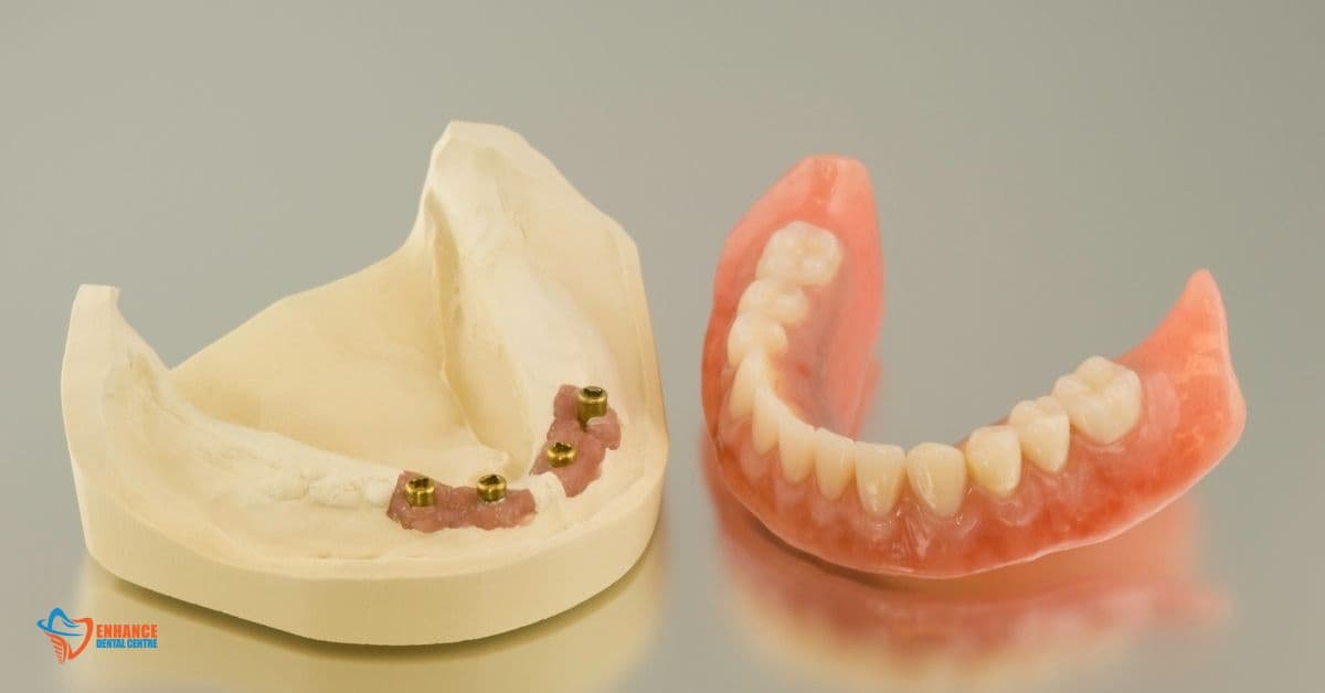 Risks of Implant-Supported Dentures