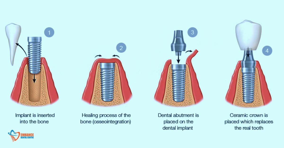 The Dental Implant Process