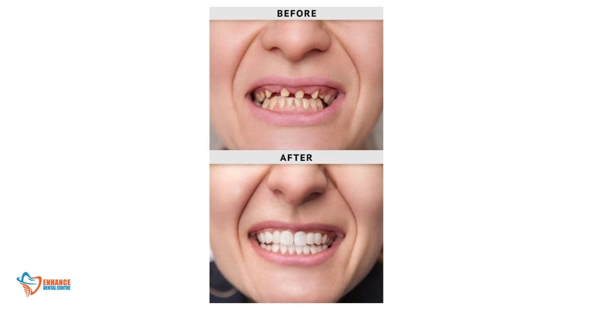 The Power of Dentures (Before & After Photos)