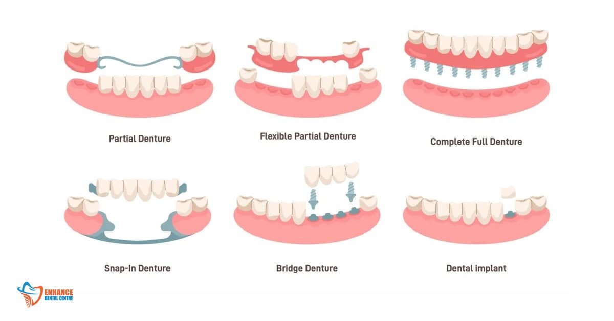 Types of Dentures