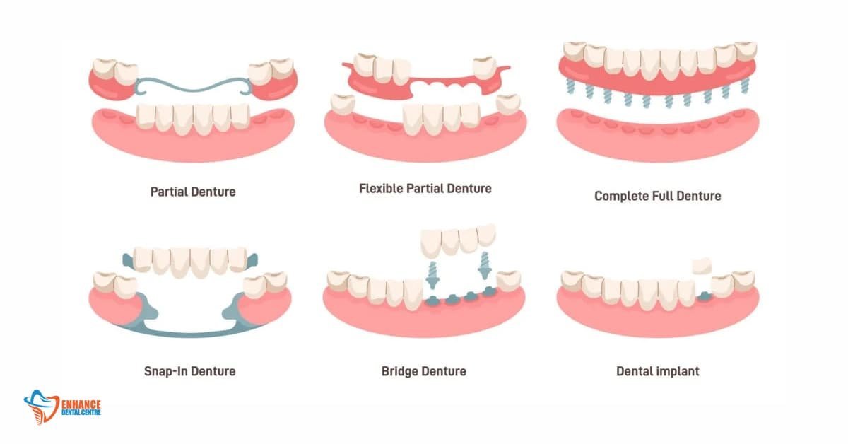Types of Dentures