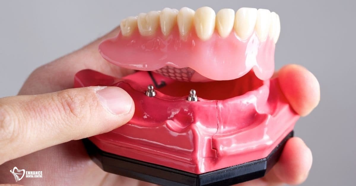 What are Implant-Supported Dentures?