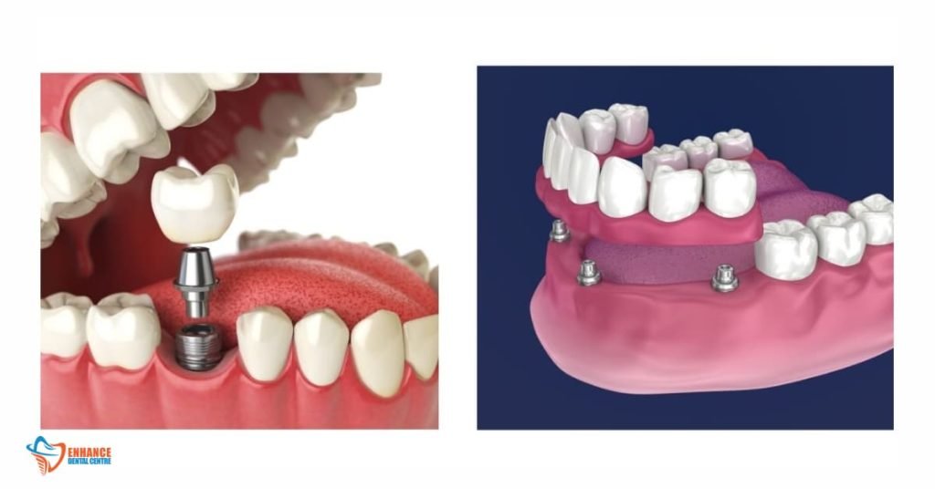 Which is the Better Option — Dentures or Dental Implants?