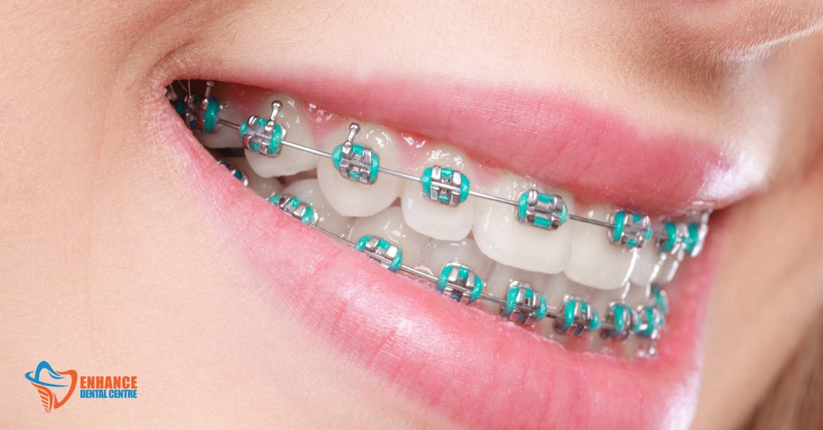 How Can Traditional Braces Treat an Overbite