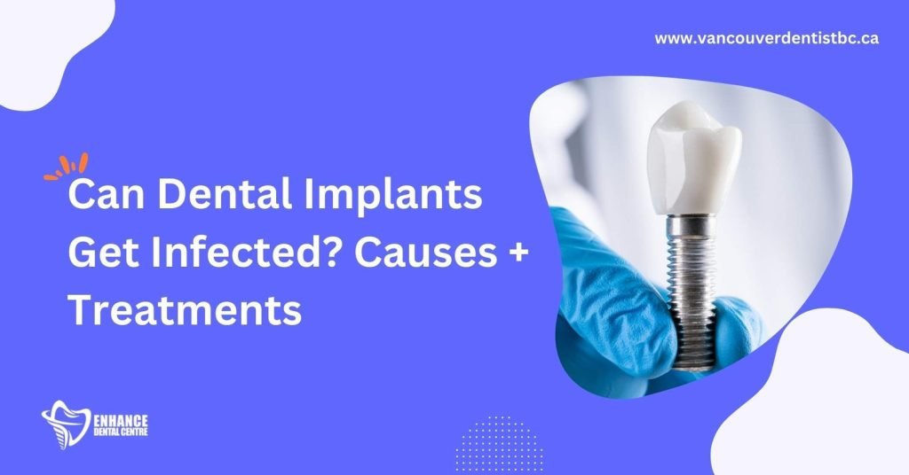 Can Dental Implants Get Infected