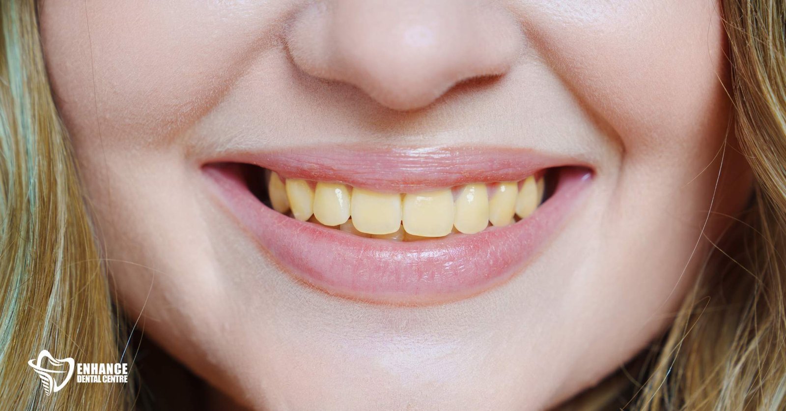 Discoloured Teeth
