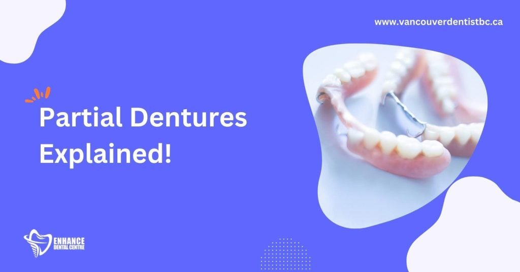 Everything You Need to Know About Partial Dentures