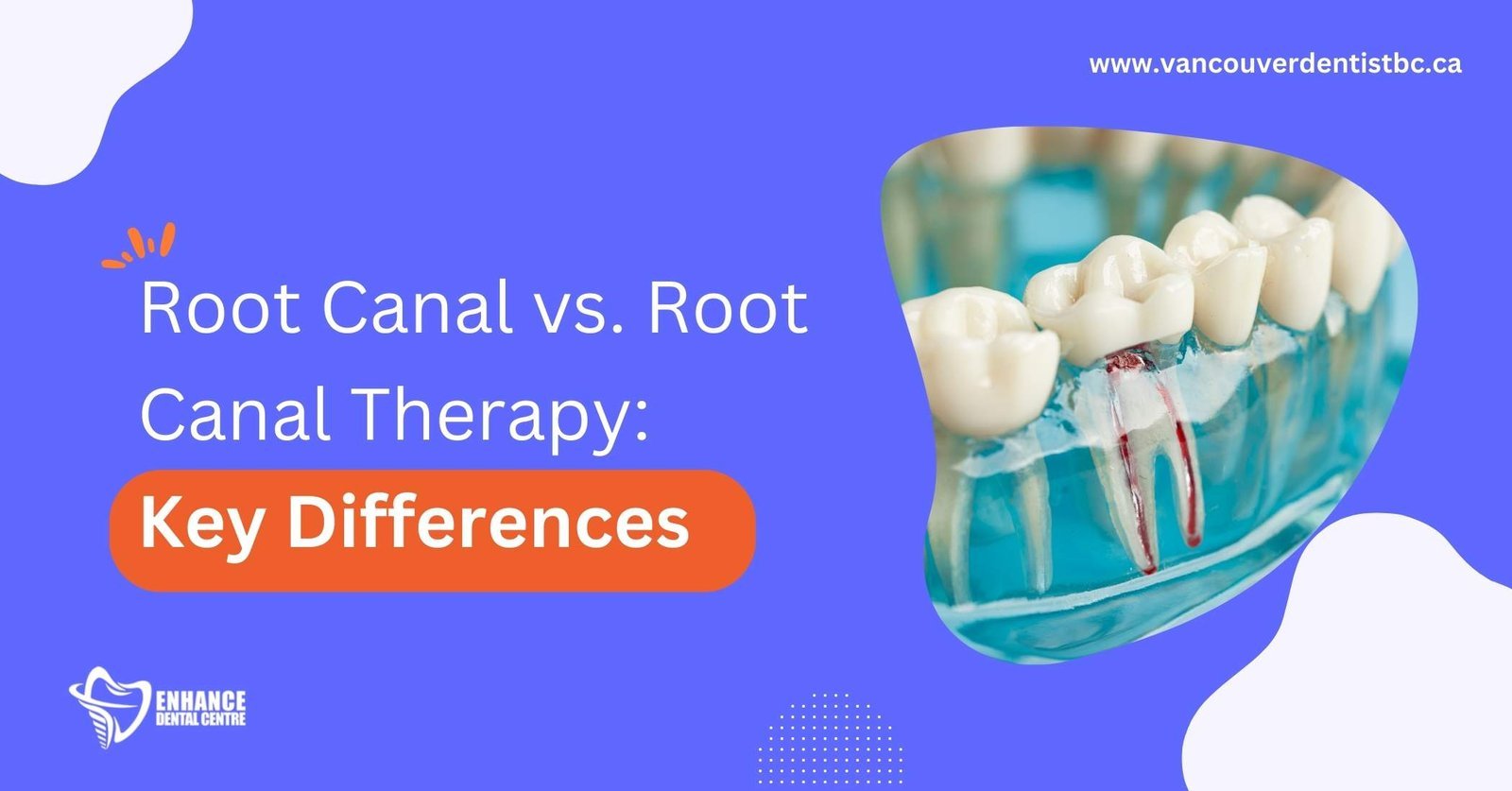 Root Canal vs. Root Canal Therapy
