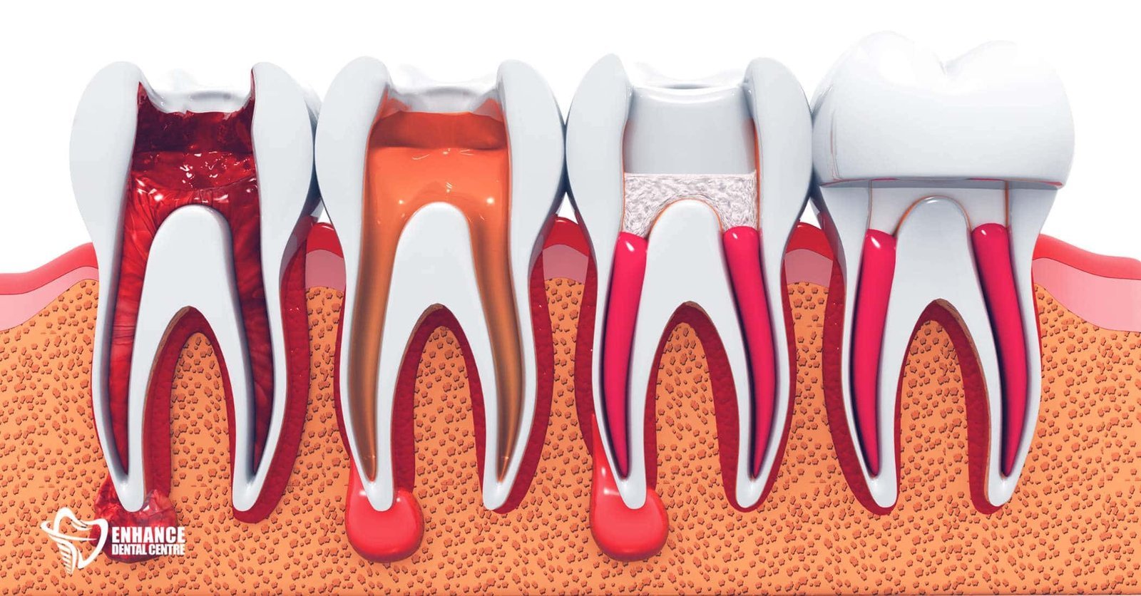 Anatomy of a Root Canal