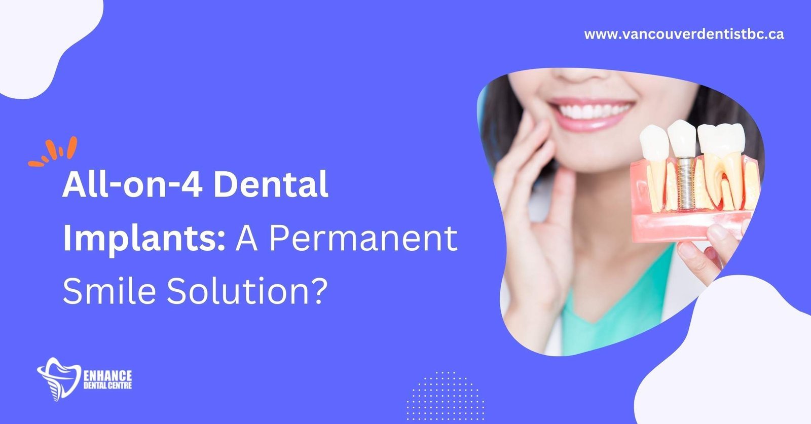 All-on-4 Dental Implants: Benefits & Candidacy Guide