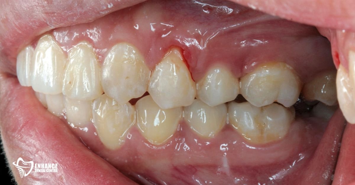 damaged gums affected by smoking