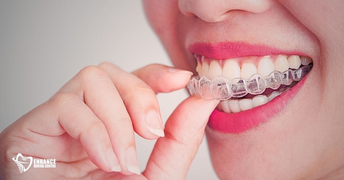 Invisalign aligners