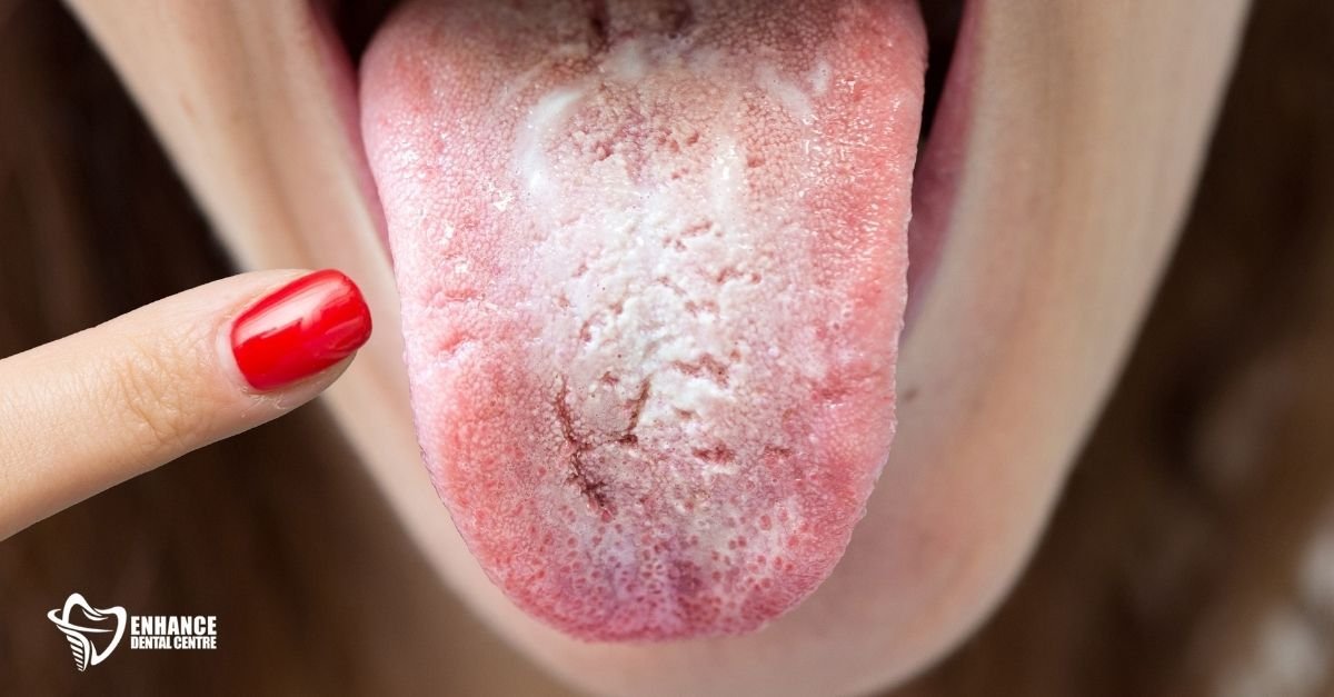 Oral thrush showing white patches inside the mouth
