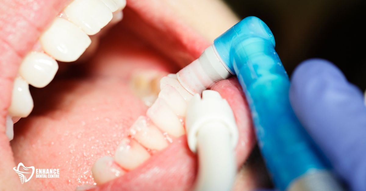 Dental hygienist performing a professional cleaning on a patient