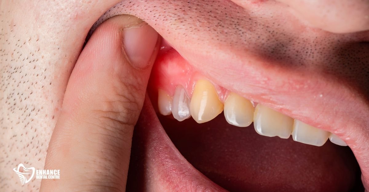 Swollen, receding gums with signs of gum disease in a smoker