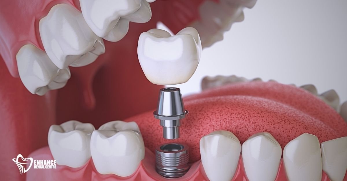 Step-by-step illustration of the dental implant process