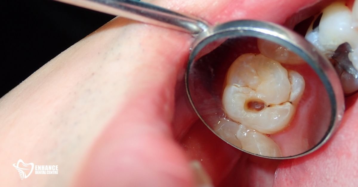Teeth with early cavities
