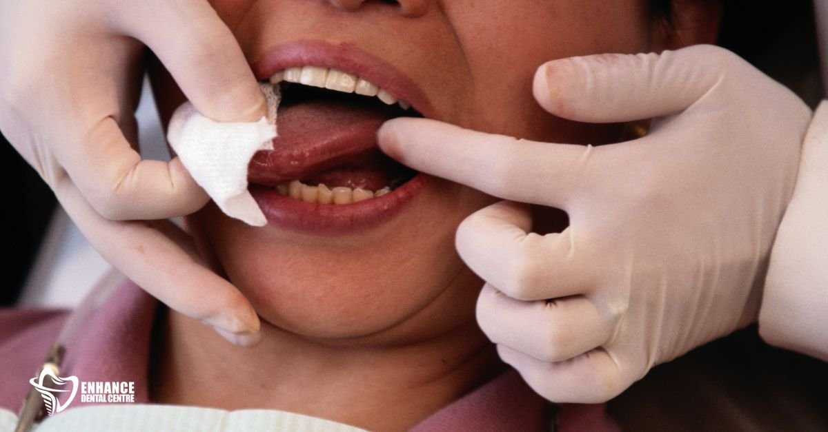 a dry mouth caused by Sjögren’s syndrome
