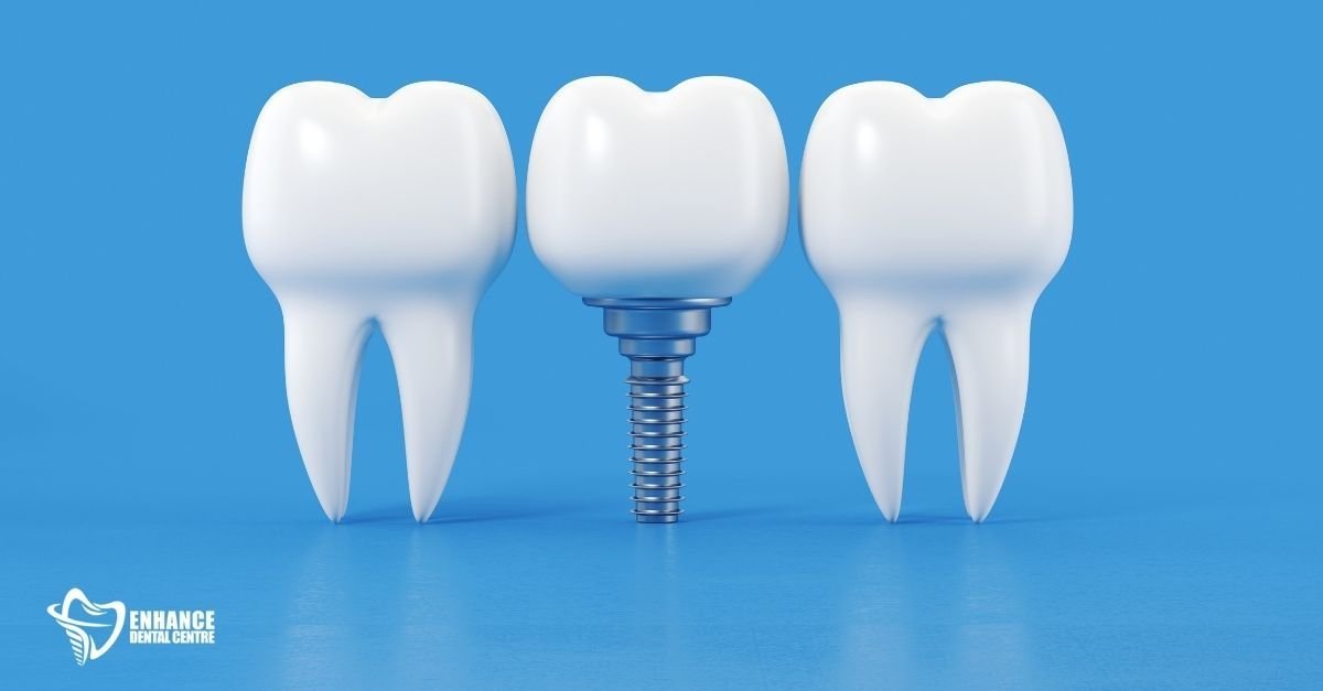 Dental implant placed in the jawbone