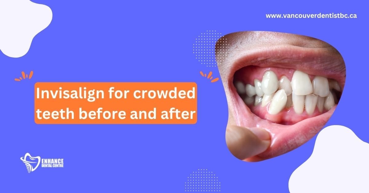 Before and After Invisalign® for Crowded Teeth