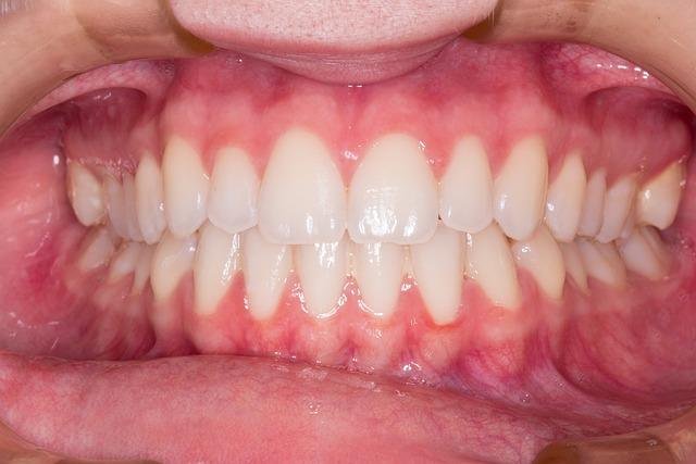 Zoom teeth whitening and bleaching in Vancouver