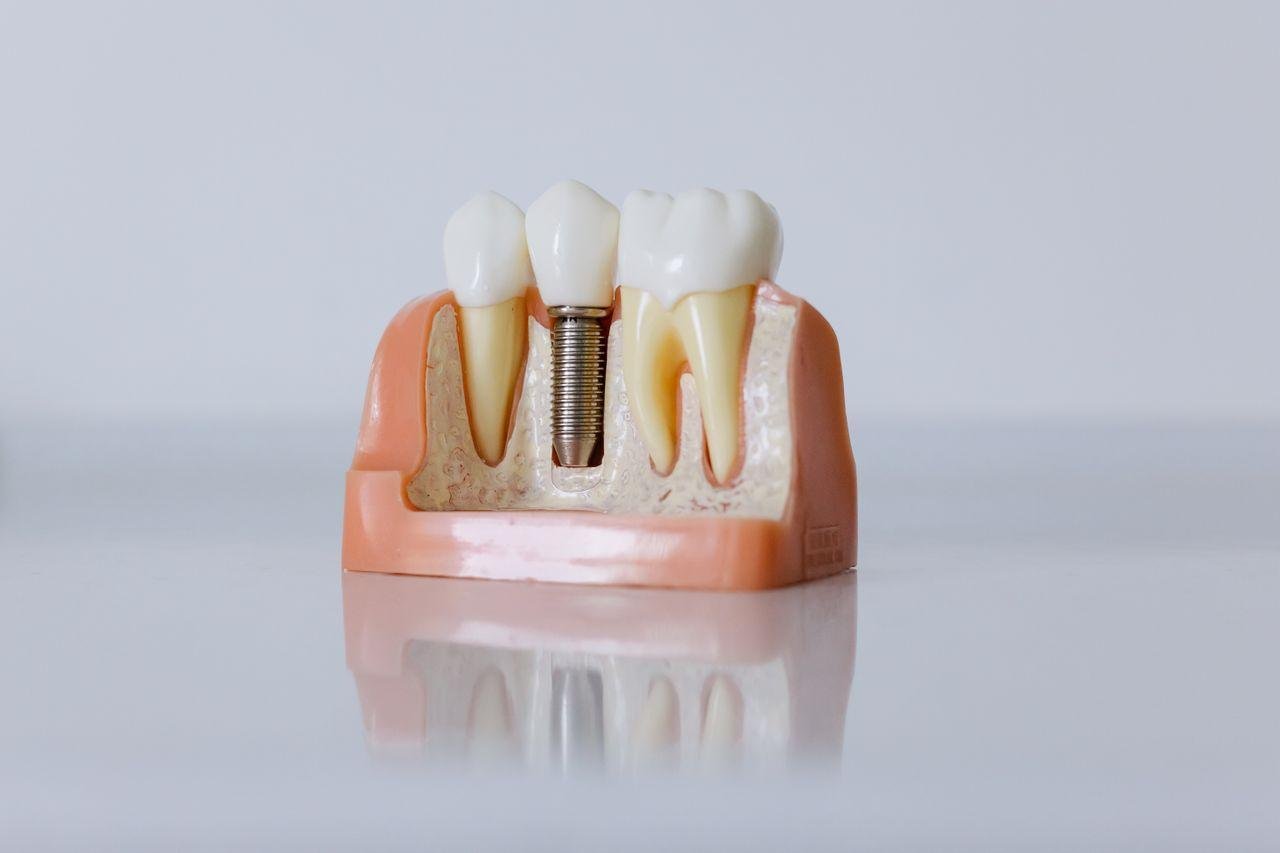 Porcelain Veneers in Kitsilano: A Complete Guide to a Natural Looking Smile