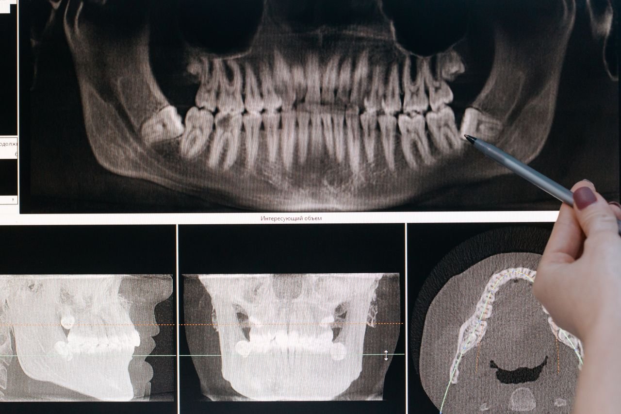 Close-up of a dental X-ray of teeth