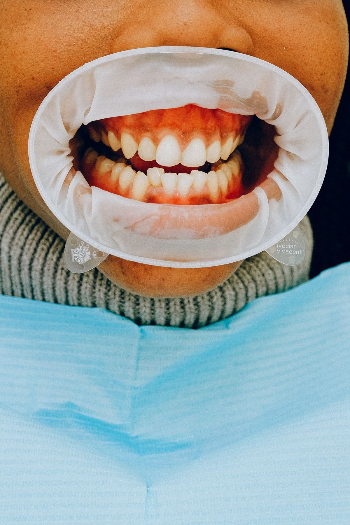Detailed view of a dental check during aligner treatment
