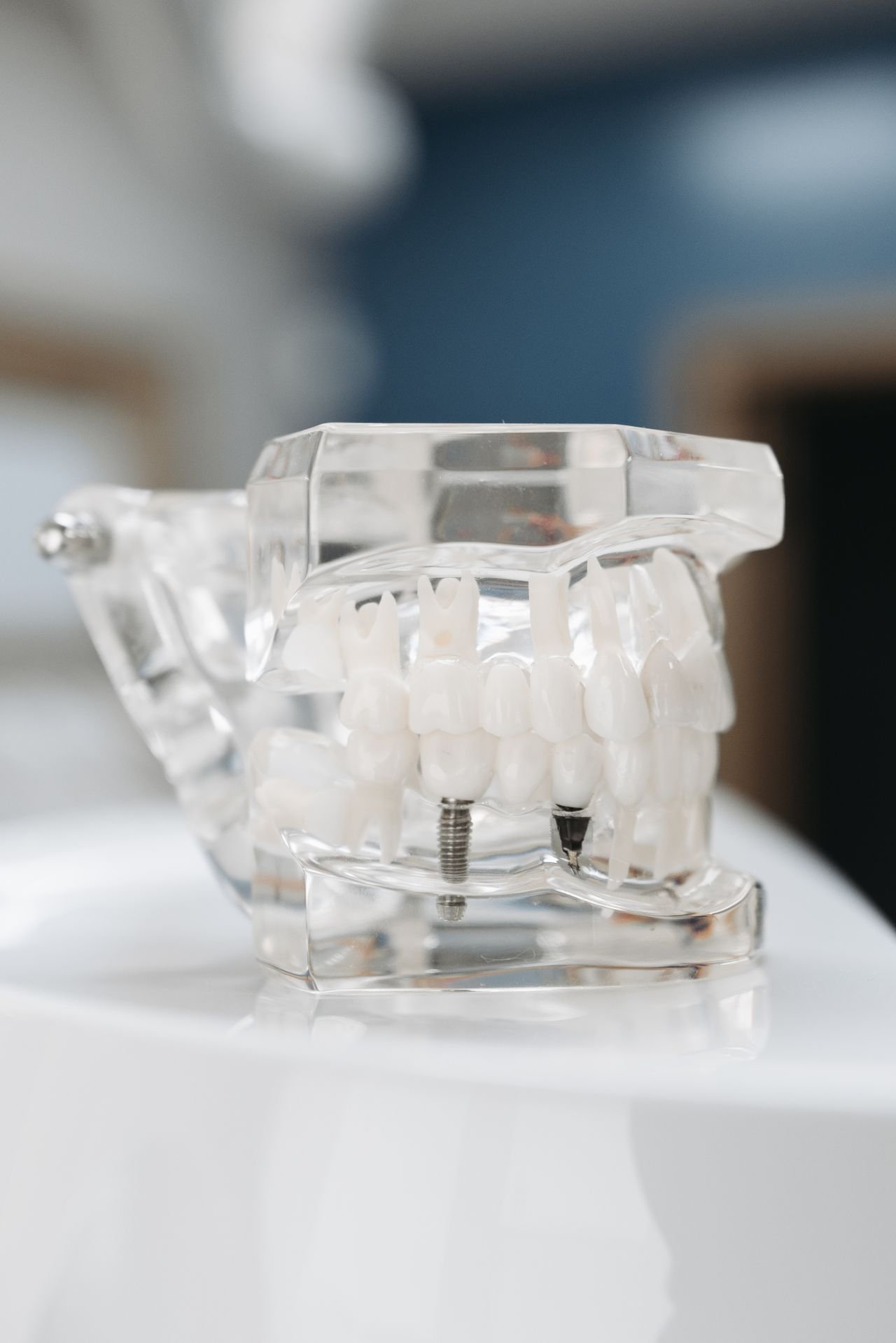 Transparent model of a dental implant in the jaw
